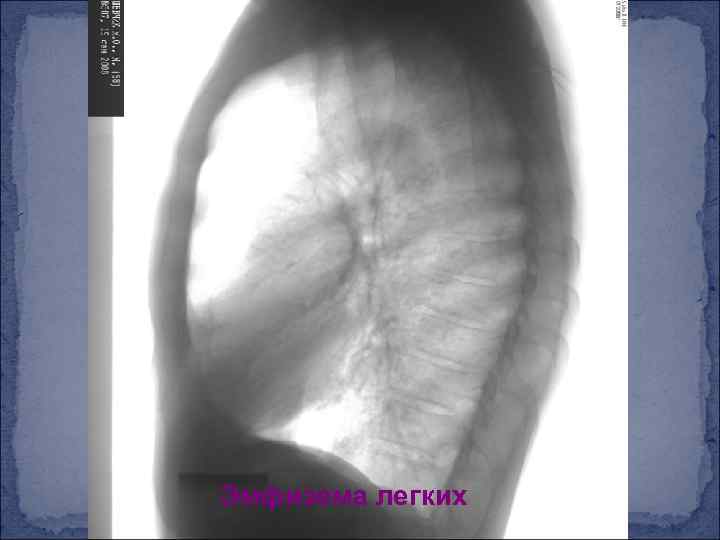 Эмфизема легких 