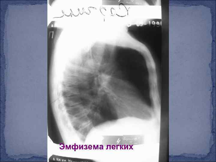 Эмфизема легких 