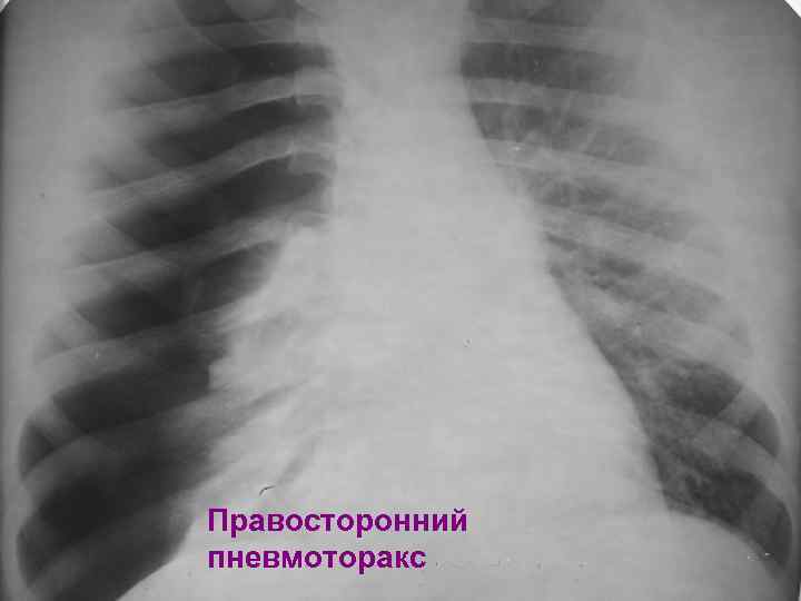Правосторонний пневмоторакс 