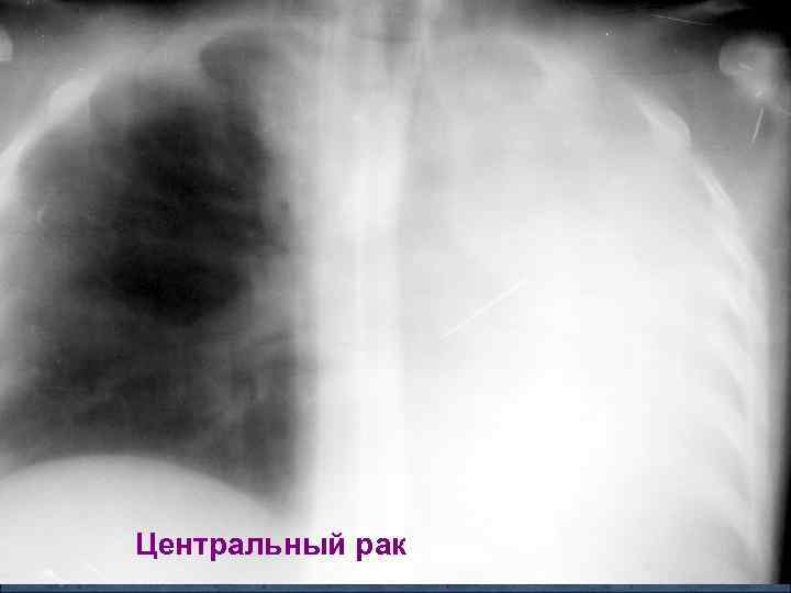 Центральный рак 