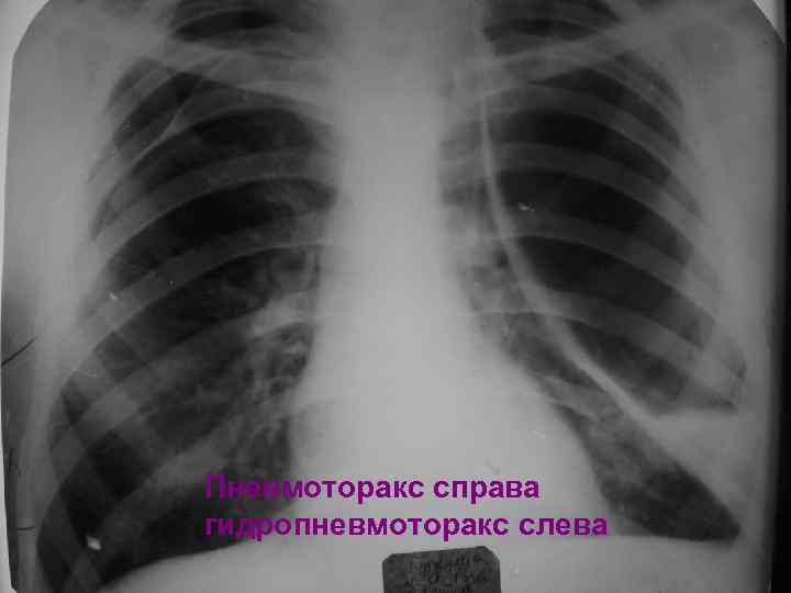 Пневмоторакс справа гидропневмоторакс слева 
