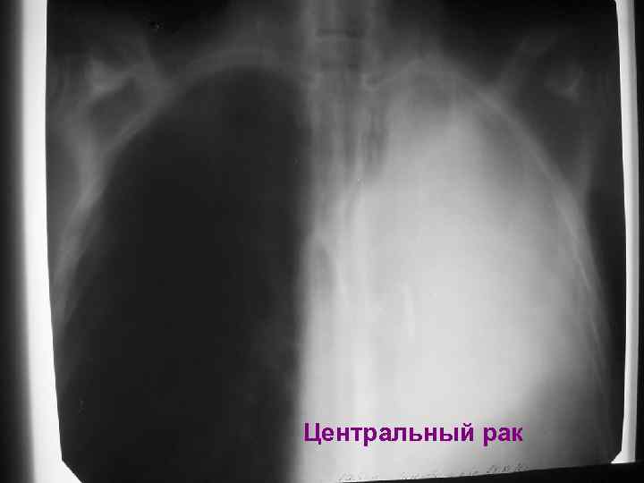 Центральный рак 