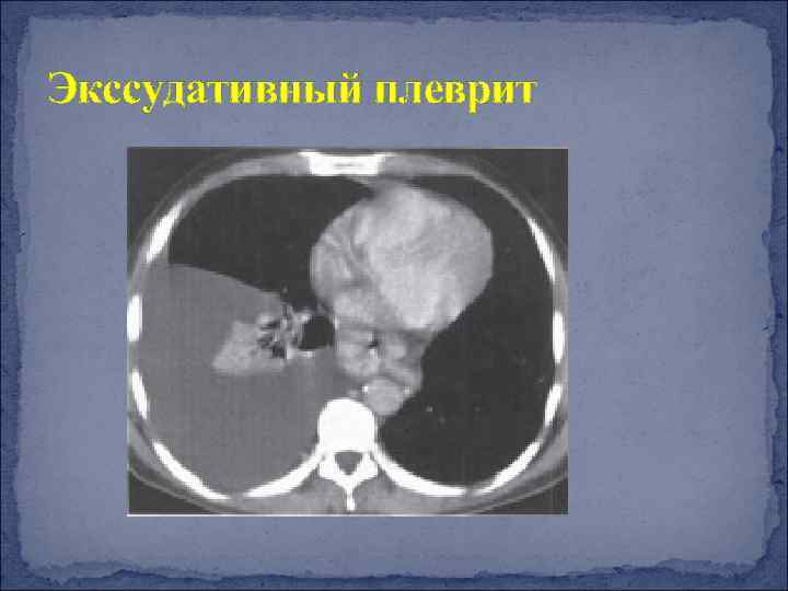 Экссудативный плеврит 