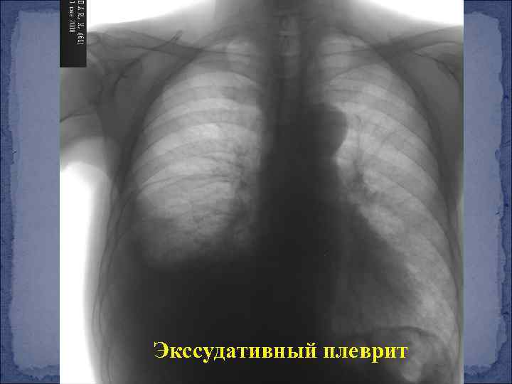 Рентгенологическая картина при экссудативном плеврите