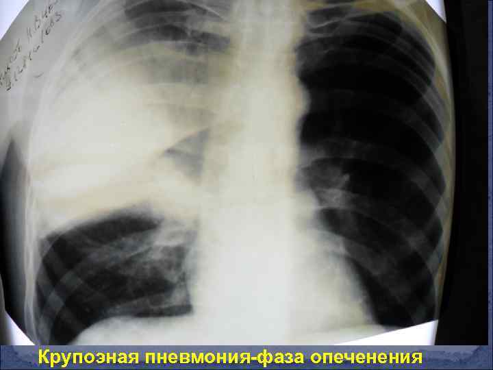 Крупоэная пневмония-фаза опеченения 