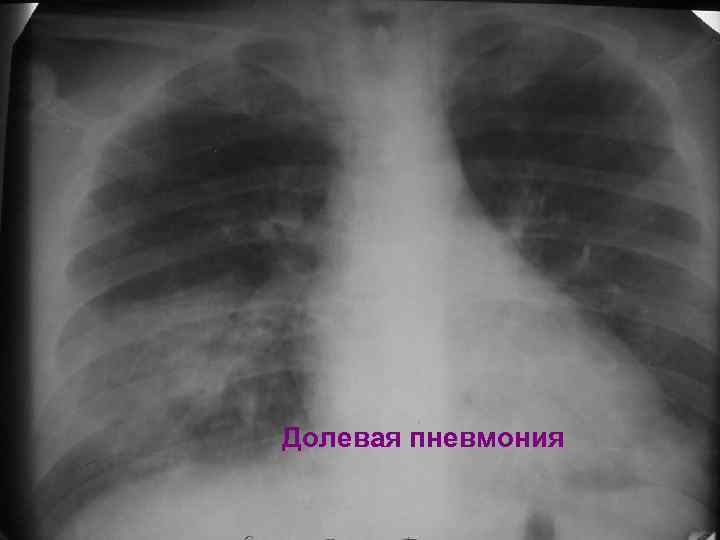 Долевая пневмония 