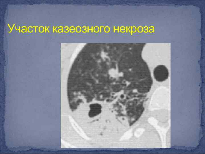 Участок казеозного некроза 