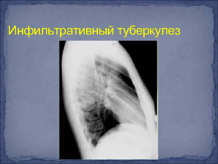 Инфильтративный туберкулез 