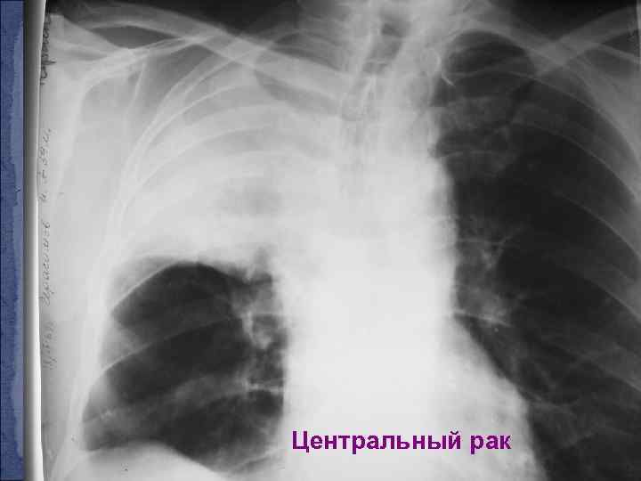 Центральный рак 