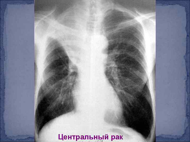 Центральный рак 