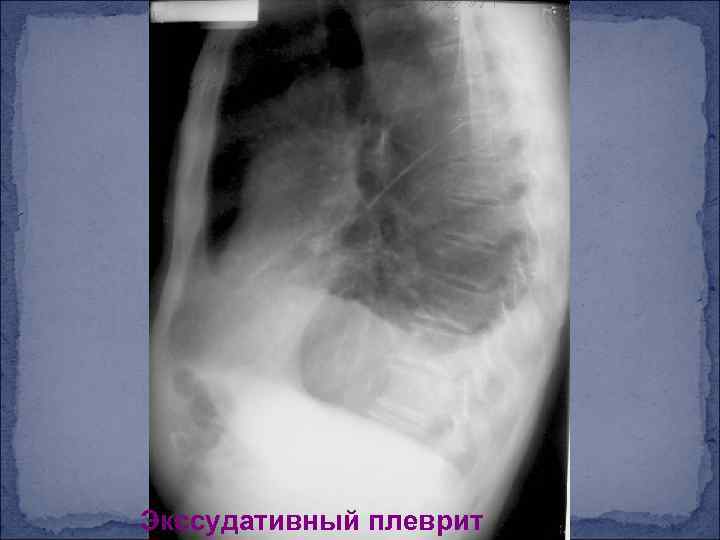 Экссудативный плеврит 