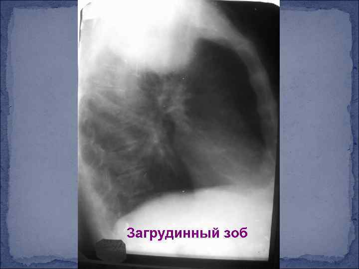 Загрудинный зоб 