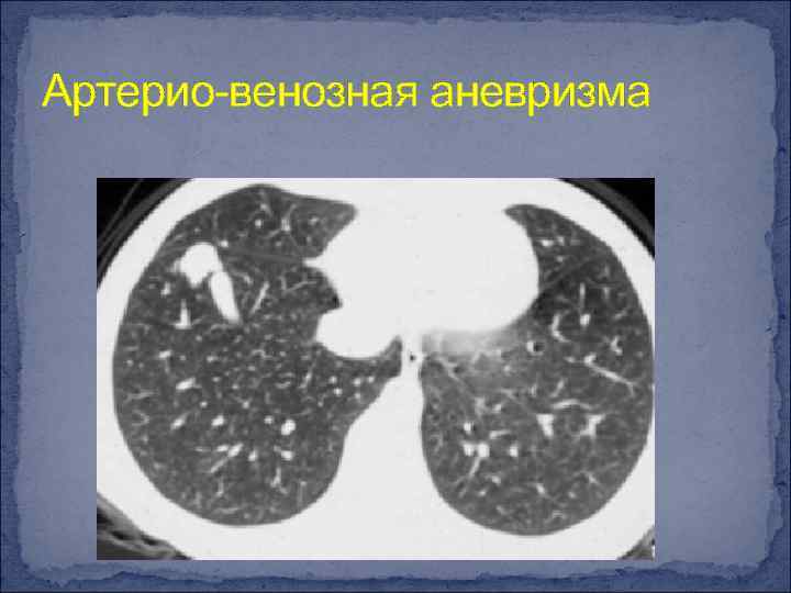 Артерио-венозная аневризма 