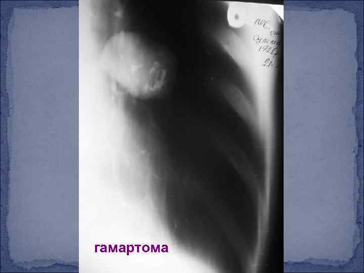 гамартома 