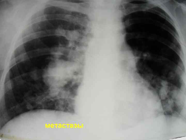 метастазы 