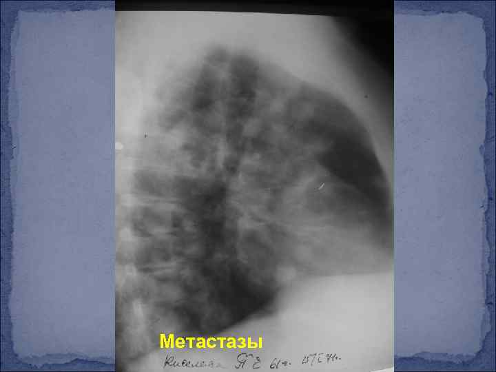 Метастазы 