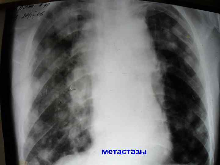 метастазы 