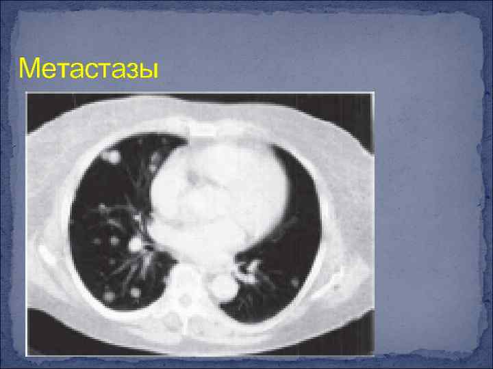 Метастазы 