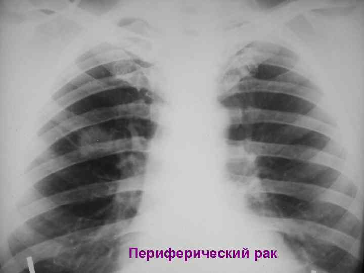 Периферический рак 