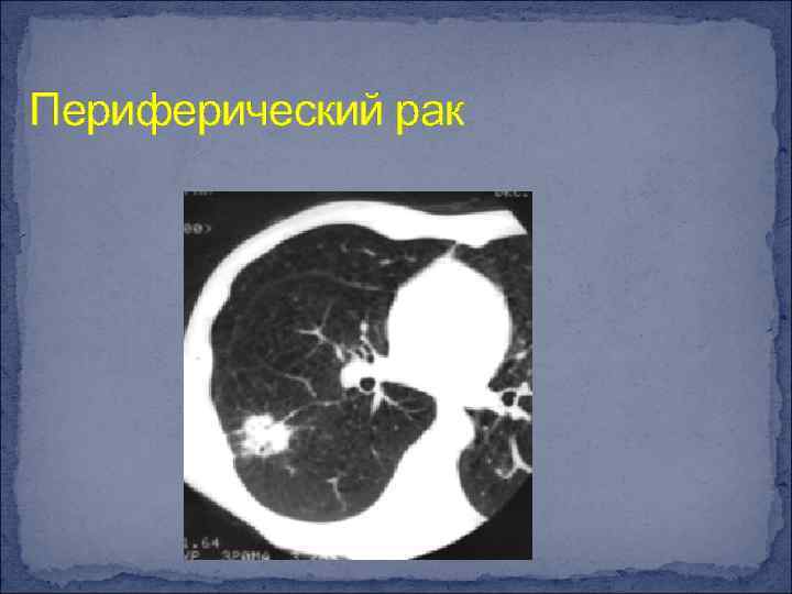 Периферический рак 