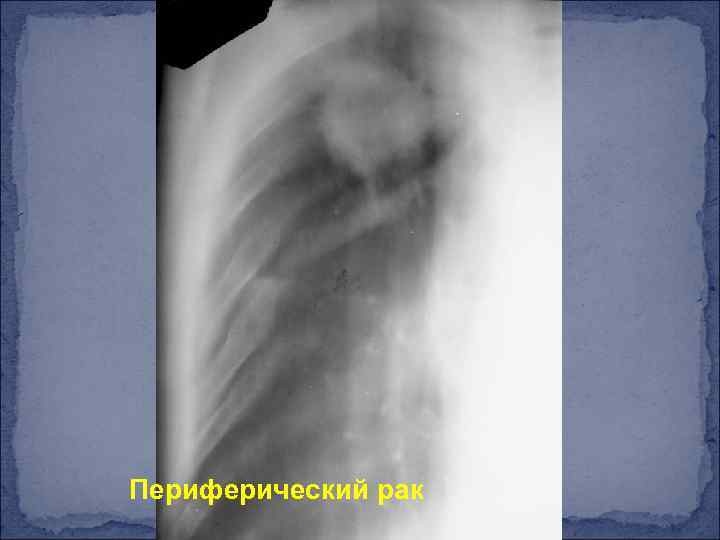 Периферический рак 