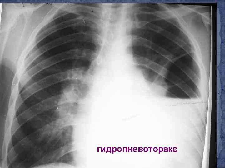гидропневоторакс 