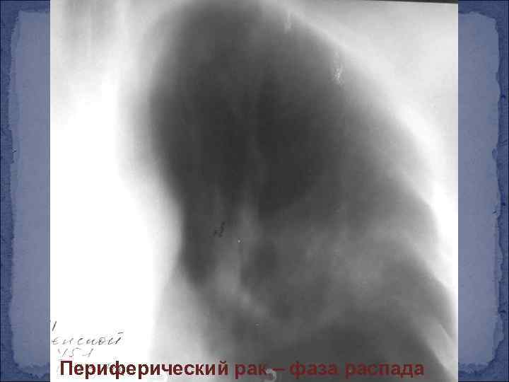 Периферический рак – фаза распада 