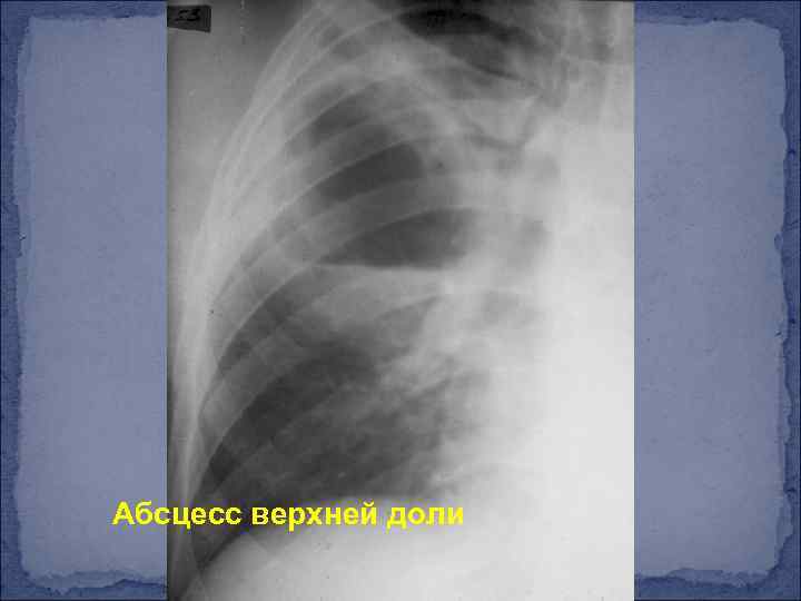 Абсцесс верхней доли 