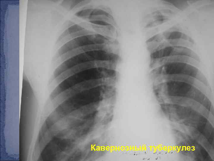 Кавернозный туберкулез 
