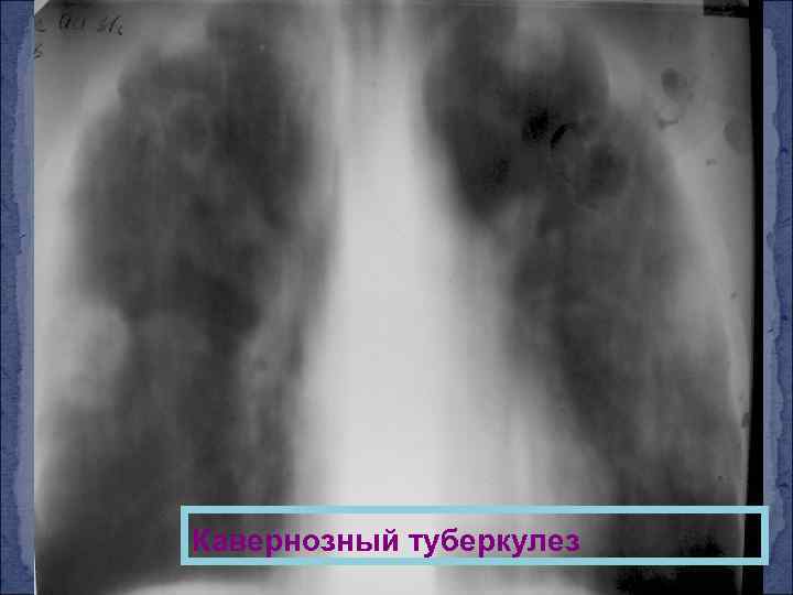 Кавернозный туберкулез 