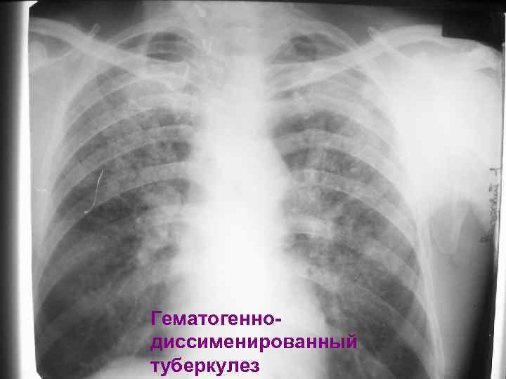 Гематогеннодиссименированный туберкулез 