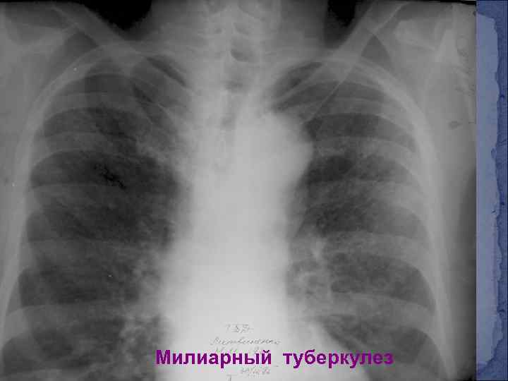Милиарный туберкулез 