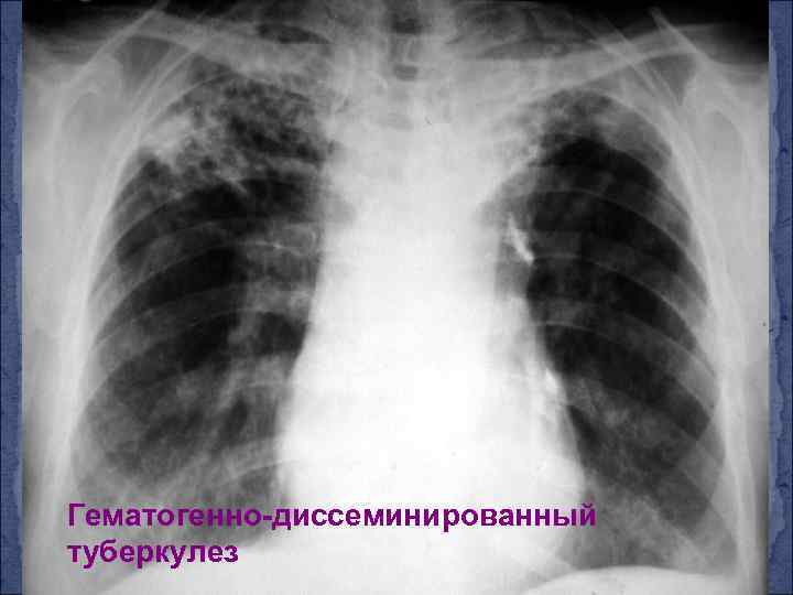 Гематогенно-диссеминированный туберкулез 
