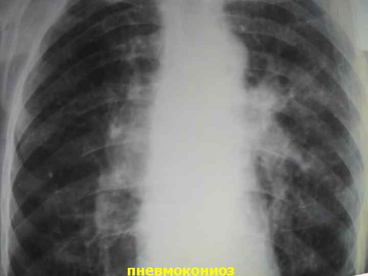 пневмокониоз 
