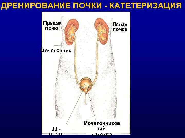 ДРЕНИРОВАНИЕ ПОЧКИ - КАТЕТЕРИЗАЦИЯ Правая почка Левая почка Мочеточник JJ стент Мочеточников ый катетер