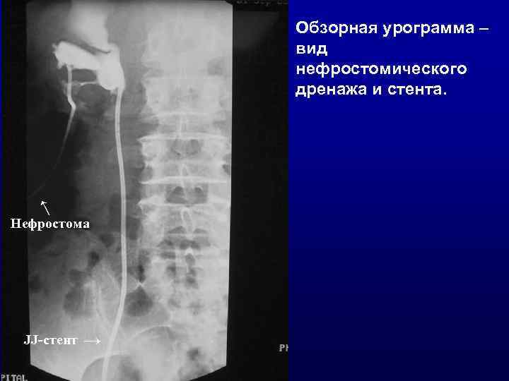 → Обзорная урограмма – вид нефростомического дренажа и стента. Нефростома JJ-стент → 