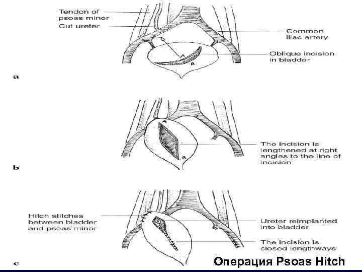 Операция Psoas Hitch 