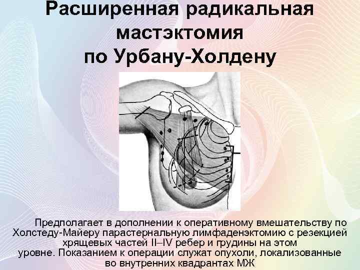 Расширенная радикальная мастэктомия по Урбану-Холдену Предполагает в дополнении к оперативному вмешательству по Холстеду-Майеру парастернальную