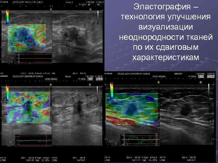Эластография – технология улучшения визуализации неоднородности тканей по их сдвиговым характеристикам 
