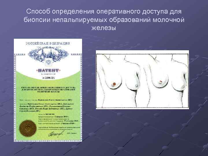 Способ определения оперативного доступа для биопсии непальпируемых образований молочной железы 