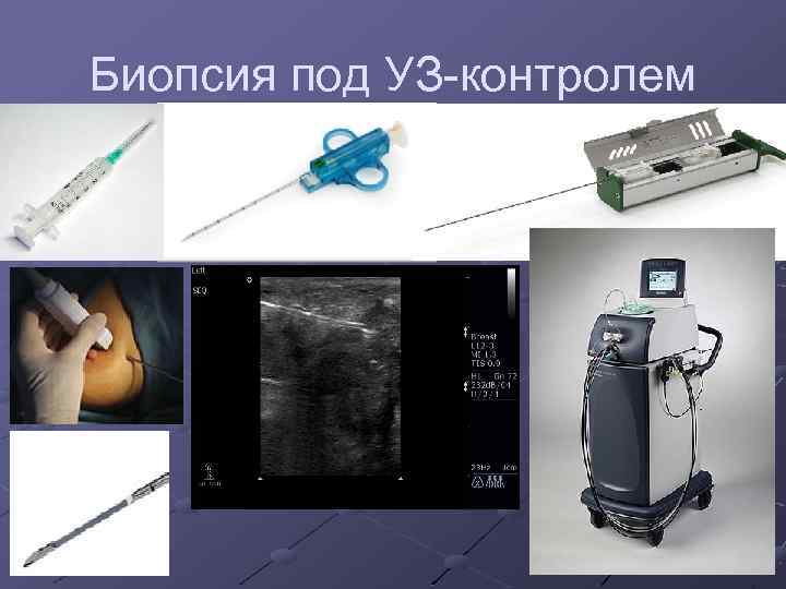 Биопсия под УЗ-контролем 