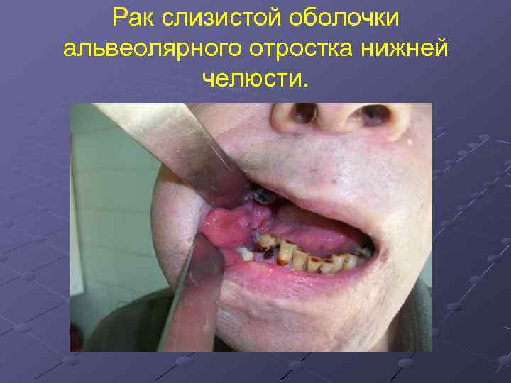 Рак слизистой оболочки альвеолярного отростка нижней челюсти. 