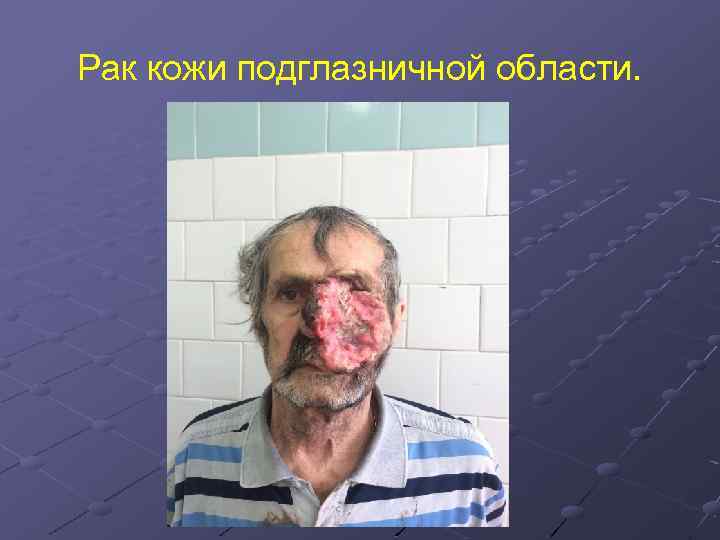 Рак кожи подглазничной области. 