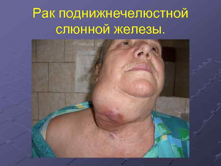 Рак поднижнечелюстной слюнной железы. 