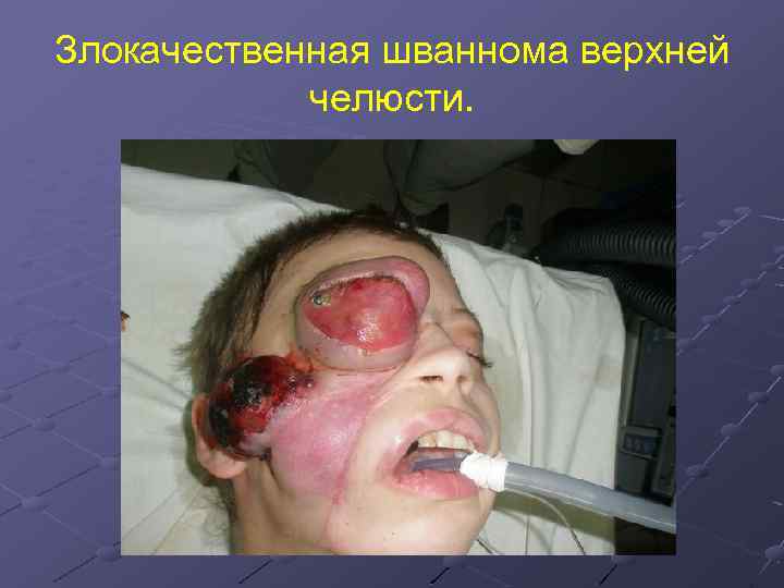 Злокачественная шваннома верхней челюсти. 