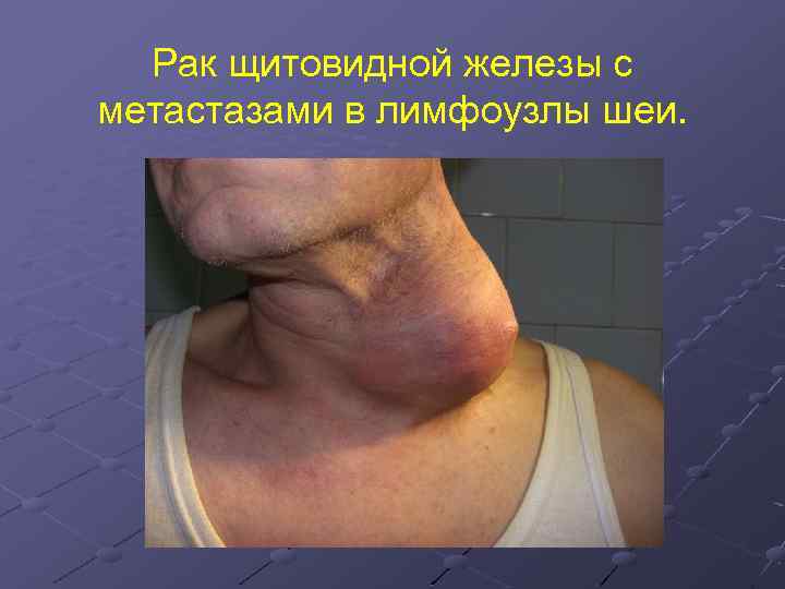 Рак щитовидной железы с метастазами в лимфоузлы шеи. 