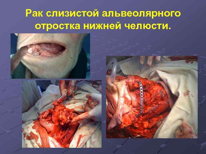 Рак слизистой альвеолярного отростка нижней челюсти. 