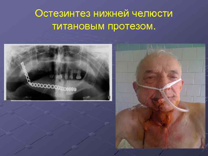 Остезинтез нижней челюсти титановым протезом. 