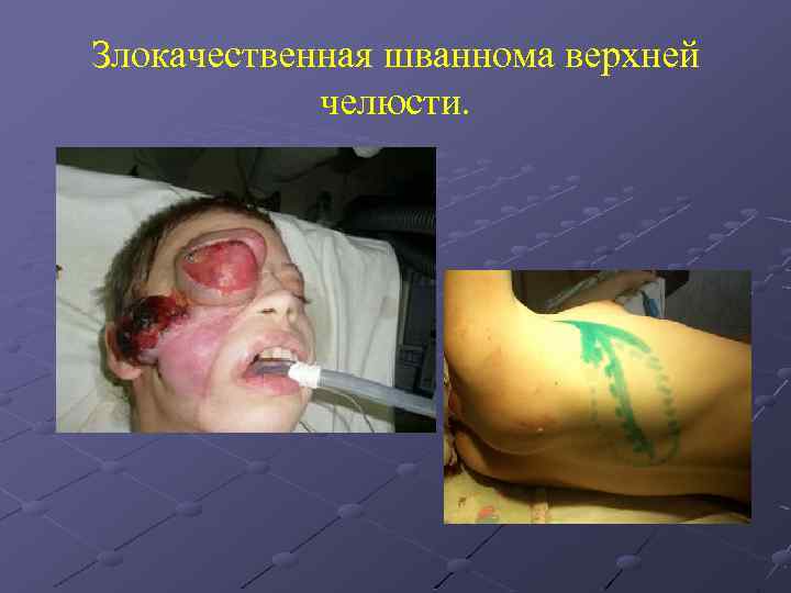 Злокачественная шваннома верхней челюсти. 