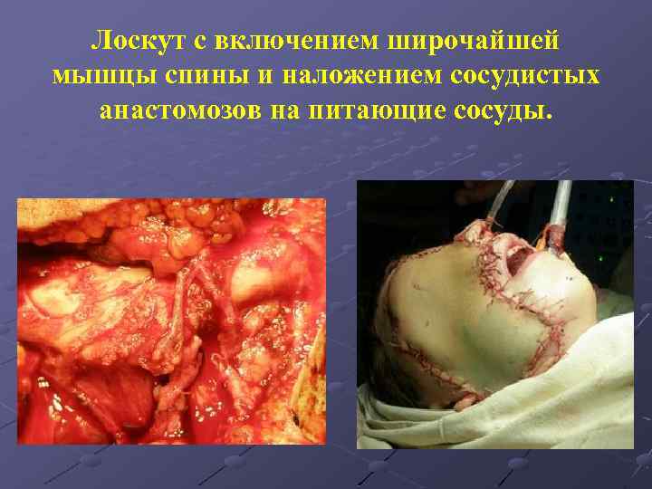 Лоскут с включением широчайшей мышцы спины и наложением сосудистых анастомозов на питающие сосуды. 
